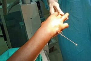 Closing reduction of Paining